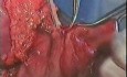 Gastric Cancer Surgery - Subtotal Gastrectomy