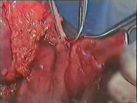 Gastric Cancer Surgery - Subtotal Gastrectomy