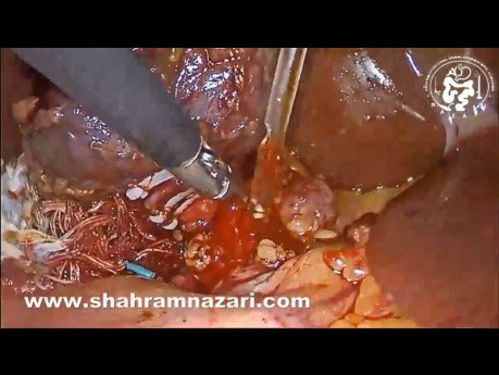 Laparoscopic Cholecystectomy, LCBD Exploration and Biliary Stenting in a Case of Sclerosing Cholangitis
