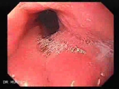 Scirrhous Gastric Carcinoma - Endoscopy (11 of 47)