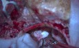 Large Vestibular Schwannoma, Retrosigmoid Approach, Gross Total Resection