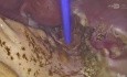 Helium Thermal Ablation of Endometriosis Over Miso Bowel