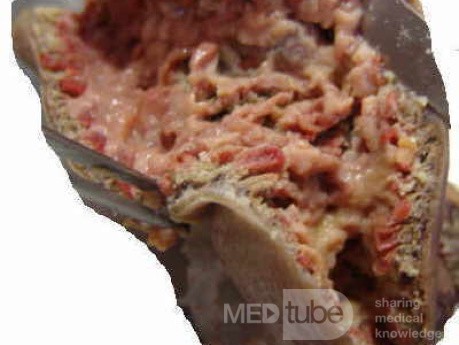 Jejunal Gastrointestinal Stromal tumor (GIST) (9 of 86)
