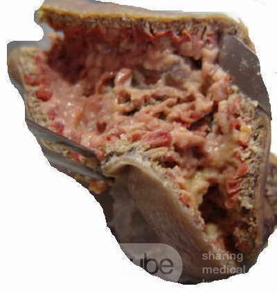 Jejunal Gastrointestinal Stromal tumor (GIST) (9 of 86)