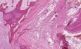 Vertebrae- Fracture Callus