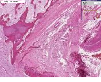 Vertebrae- Fracture Callus