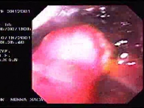 Ulcer at Anastomosis of a Billorth II Gastrectomy (2 of 4)