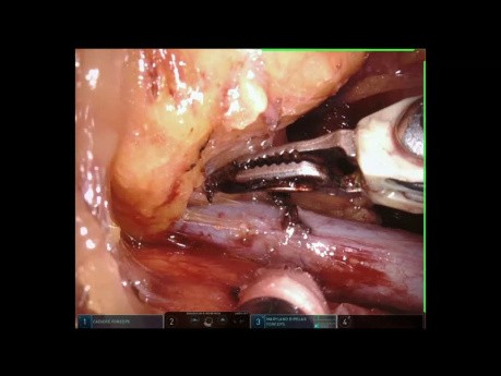 Big Mediastinal Tumor