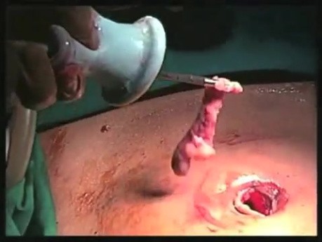 SILS Abdominal Access