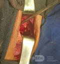 Cloward's Anterior Approach for AO Spine Type C Cervical Fracture with Brown Sequard Syndrome