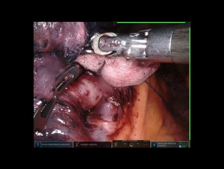 Right Upper Lobectomy - Robotic Surgery