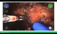 Robotic-Assisted Radical Prostatectomy Using Versius