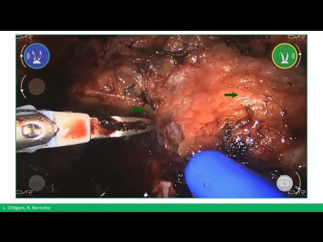 Robotic-Assisted Radical Prostatectomy Using Versius