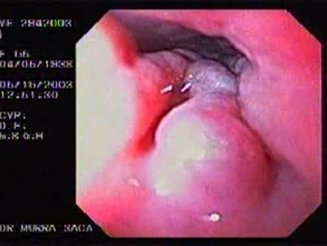 Banding of Esophageal Varices - 65 Years-Old Female
