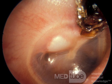 Attic Crust and Cholesteatoma