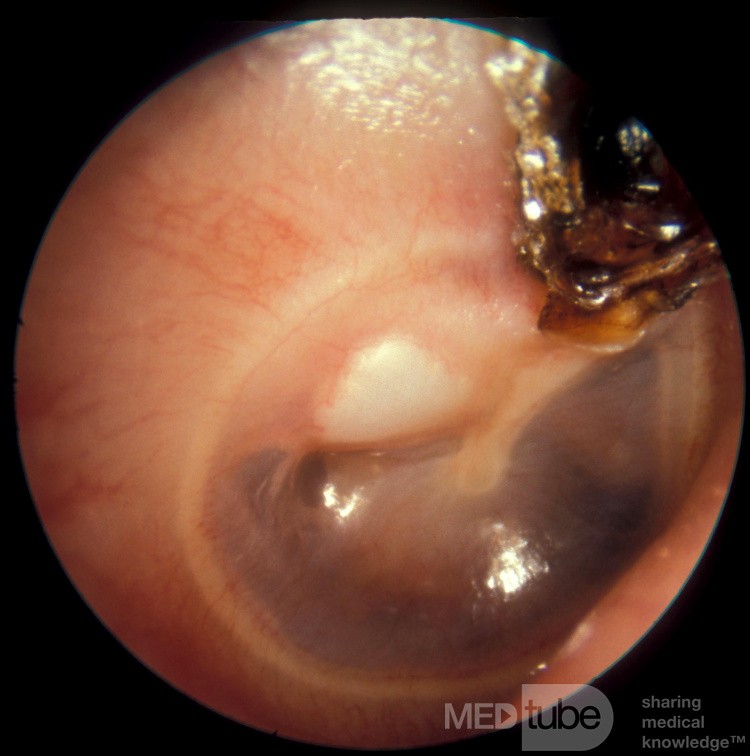 Attic Crust and Cholesteatoma