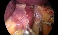 Laparoscopic Adjustable Gastric Band Surgery