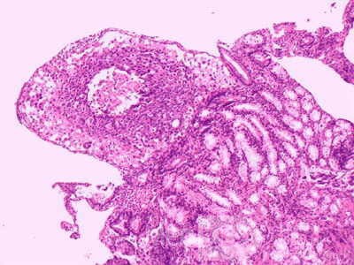 Ovarian Carcinoma Metastatic to Stomach and Duodenum (16 of 20)