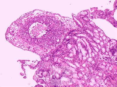 Ovarian Carcinoma Metastatic to Stomach and Duodenum (16 of 20)