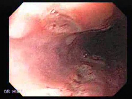 Pill Esophagitis - 5/5