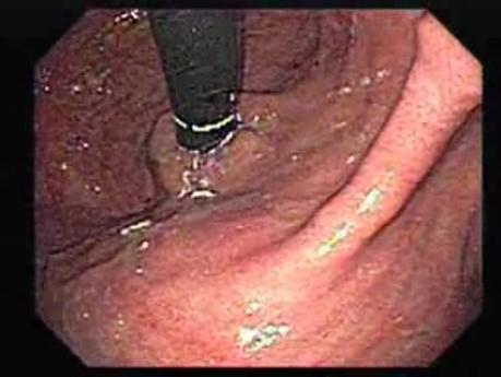 Retroflexed Image of Narrowed Gastroesophageal Junction