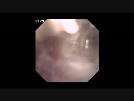 Flexible Ureteroscopy, in Complex Ureteric Stone