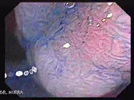 Sessile Tubulovillous Adenoma (6 of 11)