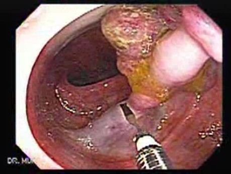 Colonoscopic Polypectomy (9 of 18)