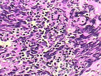 Histoplasmosis of the Colon and Condyloma Accuminata (10 of 11)