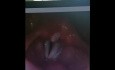 Benign Neoplasm of the Larynx. Fibroma.