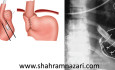 Barium Meal After Nissen Fundoplication
