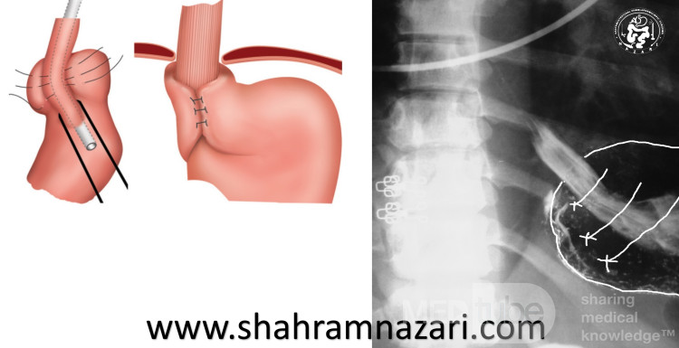 Barium Meal After Nissen Fundoplication