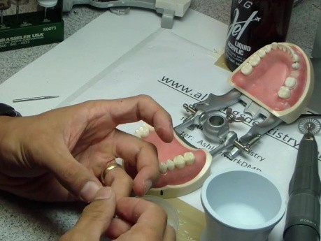 Anterior Bridge Preparation, Part 8 - Jet Provisional - Relining And Repairing Fracture