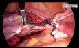 Safest Way to Perform Total Laparoscopic Hysterectomy with Bilateral Salpingo-oophorectomy