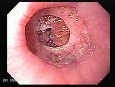 Scirrhous Gastric Carcinoma - Endoscopy (46 of 47)