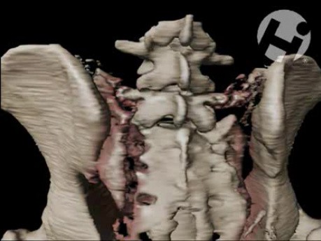Volumated Pelvis