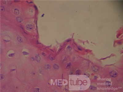 Candida Esophagitis - Endoscopy  (5 of 5)