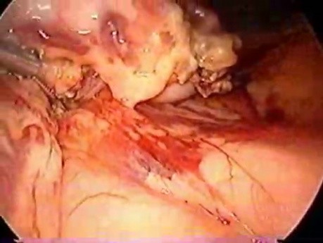 Laparoscopic distal pancreatectomy with splenectomy
