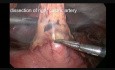 Laparoscopic-Thoracoscopic Esophagectomy