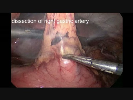 Laparoscopic-Thoracoscopic Esophagectomy