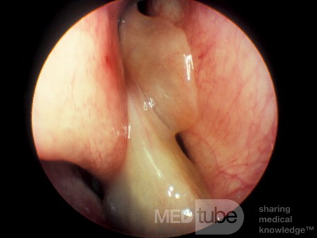 Nasal Polyps Arising from the Spheno-ethmoidal Recess