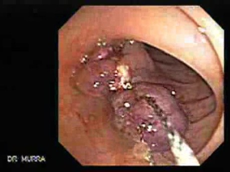Polypectomy of Stalked Polyp (4 of 6)