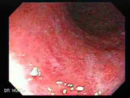 Ulcerative Colitis - Endoscopy (1 of 5)