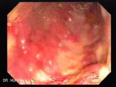 Multiple Rectal Ulcers (14 of 110)