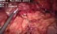 Laparoscopic Appendectomy - 19 year old girl