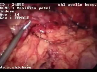 Laparoscopic Appendectomy - 19 year old girl