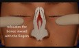 Animation of Rhinoplasty (nose job) produced by Dr Hosnani