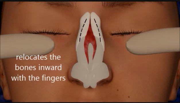 Animation of Rhinoplasty (nose job) produced by Dr Hosnani • Video •  