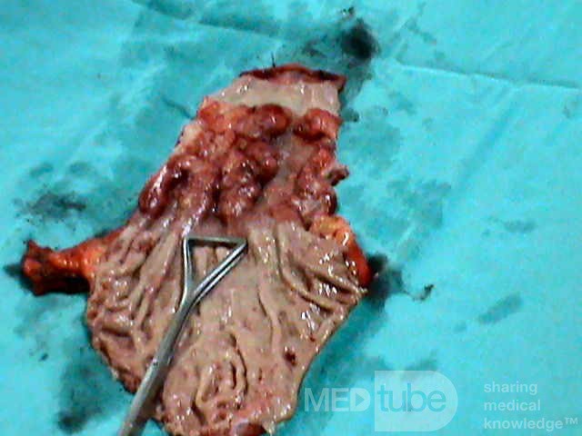 Barrett Adenocarcinoma - Endoscopic Image (19 of 20)