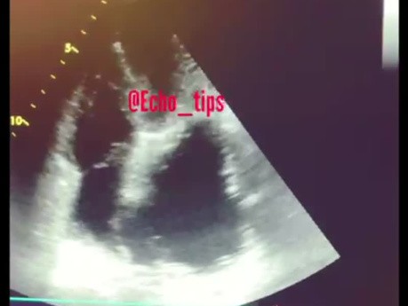 Aortic Annurysm in Echocardiography